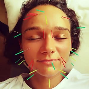 Facial Rejuvenation Acupuncture